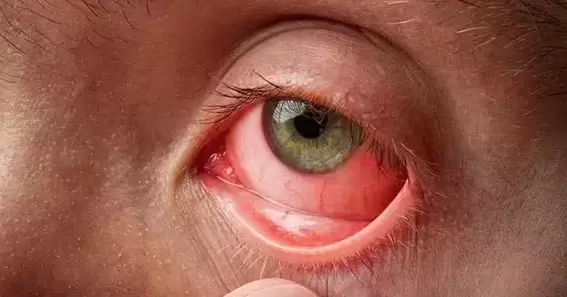 What is commonly misdiagnosed as pink eye